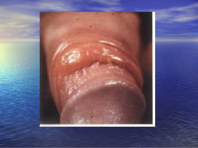 Tagomatic View Sites You Porn Staff Infection On Penis